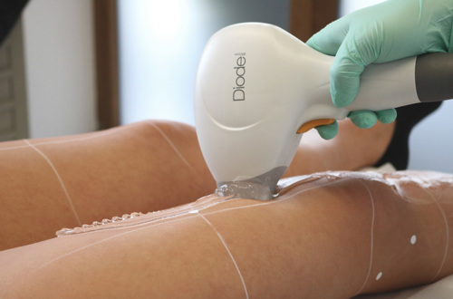 Haarentfernung Diodenlaser